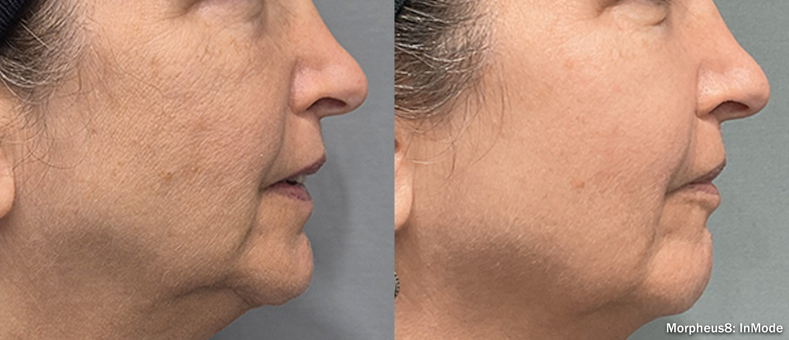 Side view of a woman's lower face at the start and three months into a Morpheus8 series, credited to InMode, not a patient of this practice