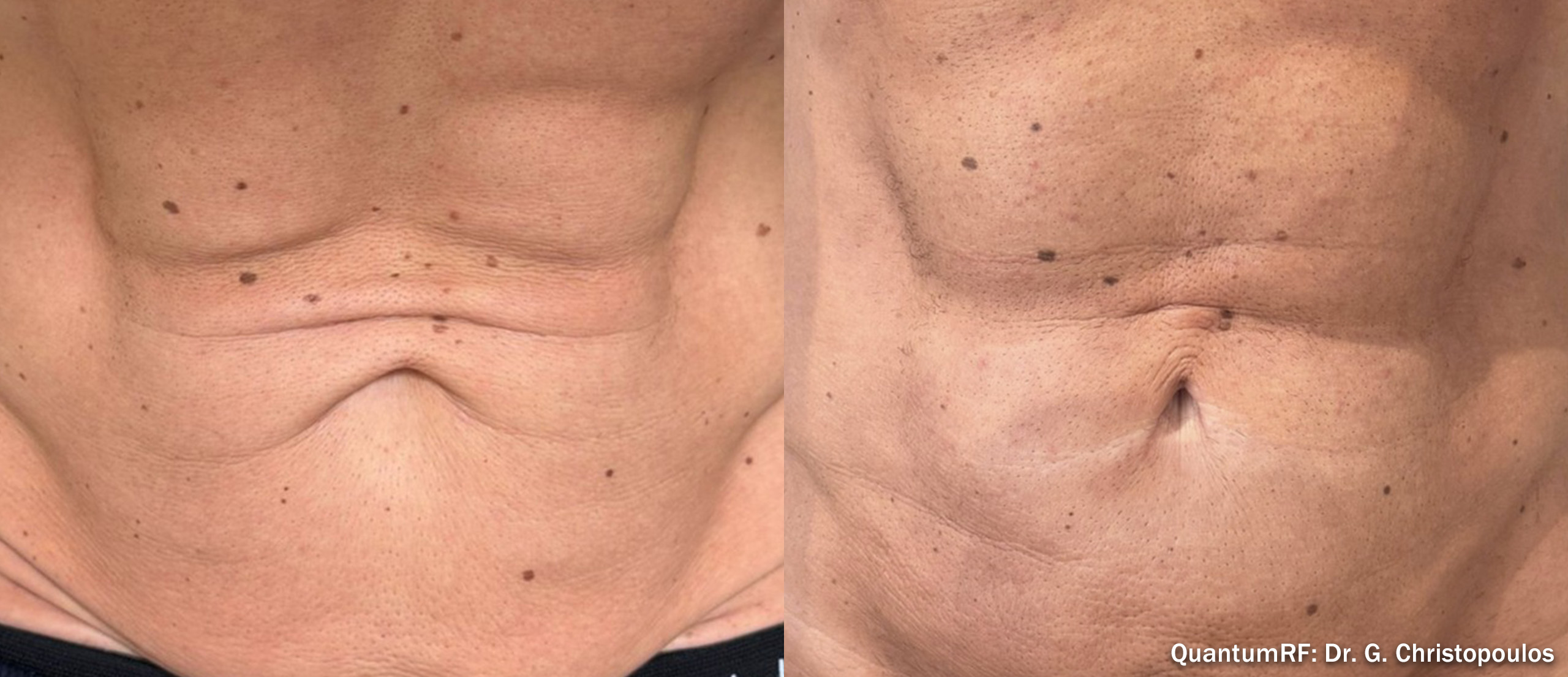 Side by side frames of a man's abdomen across a QuantumRF course, credited to Dr. G. Christopoulos, not a patient of this practice
