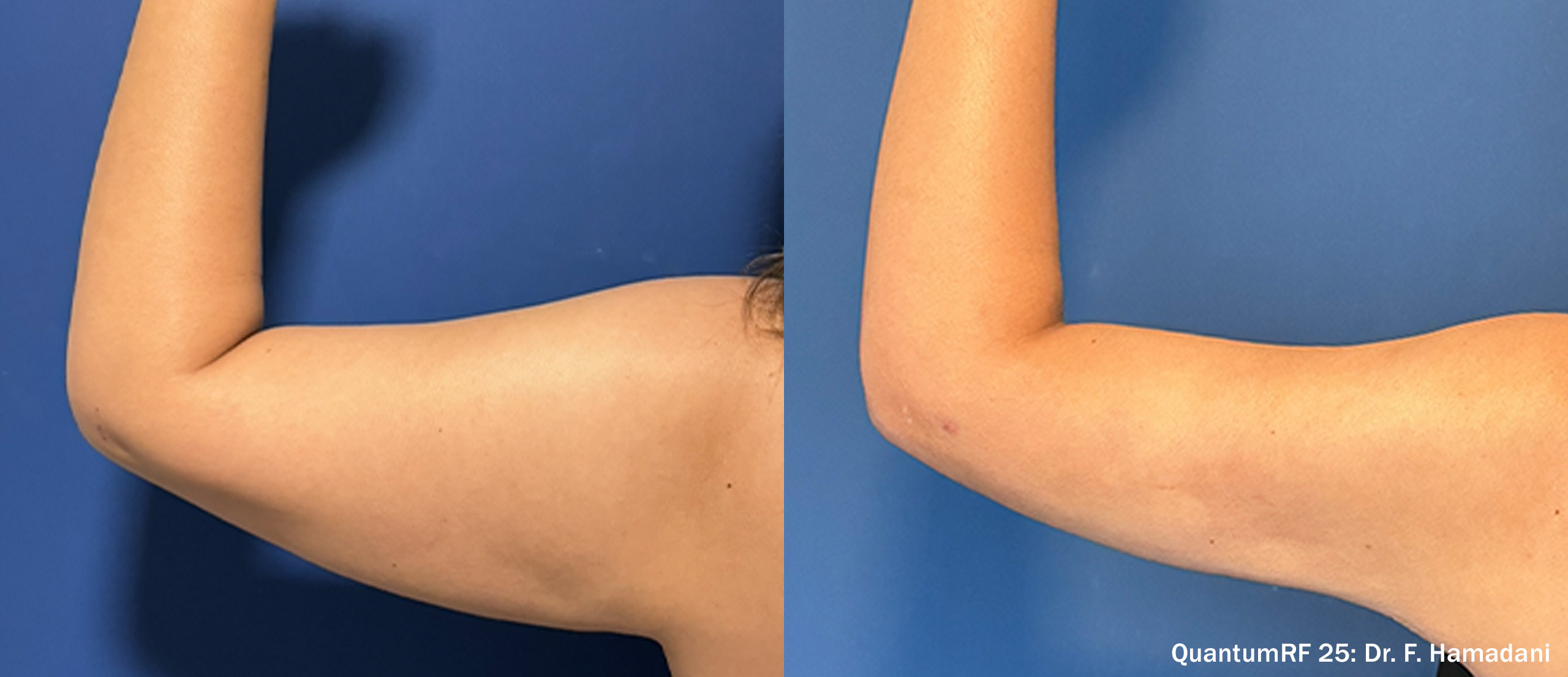 Side by side frames of an upper arm from behind across a QuantumRF 25 course, credited to Dr. F. Hamadani, not a patient of this practice.