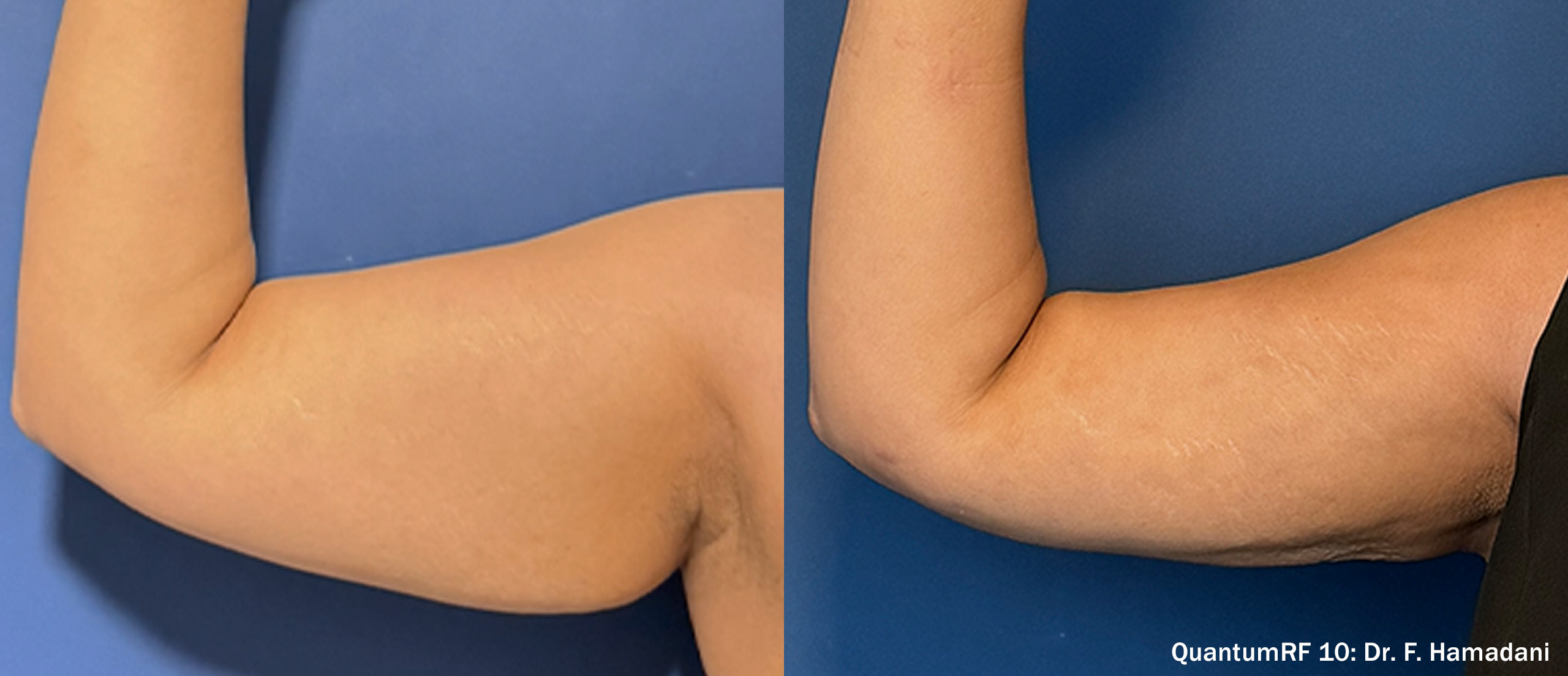 Side by side frames of an upper arm from the front across a QuantumRF 10 course, credited to Dr. F. Hamadani, not a patient of this practice.