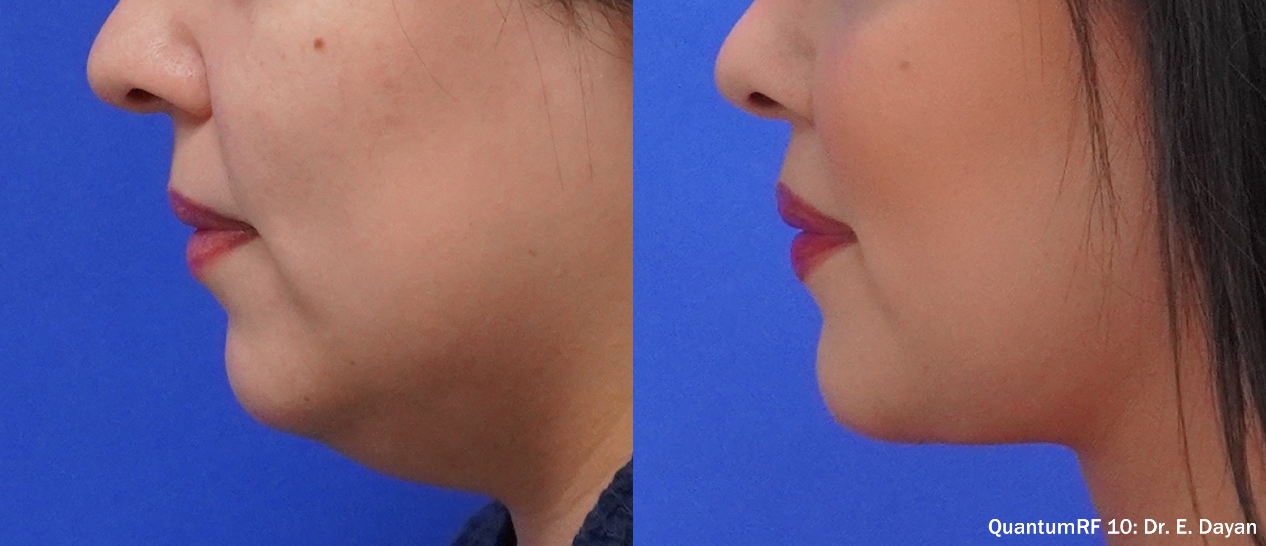 Side by side frames of a jawline and chin across a QuantumRF 10 course, credited to Dr. E. Dayan, not a patient of this practice.