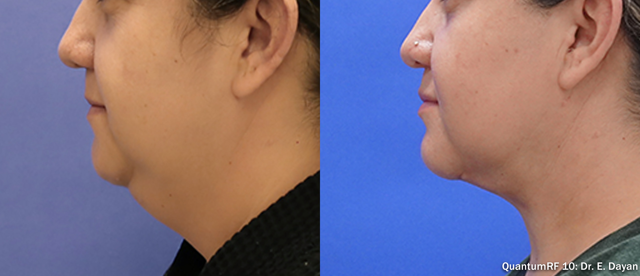 Side by side frames of a chin and jaw in profile across a QuantumRF 10 course, credited to Dr. E. Dayan, not a patient of this practice