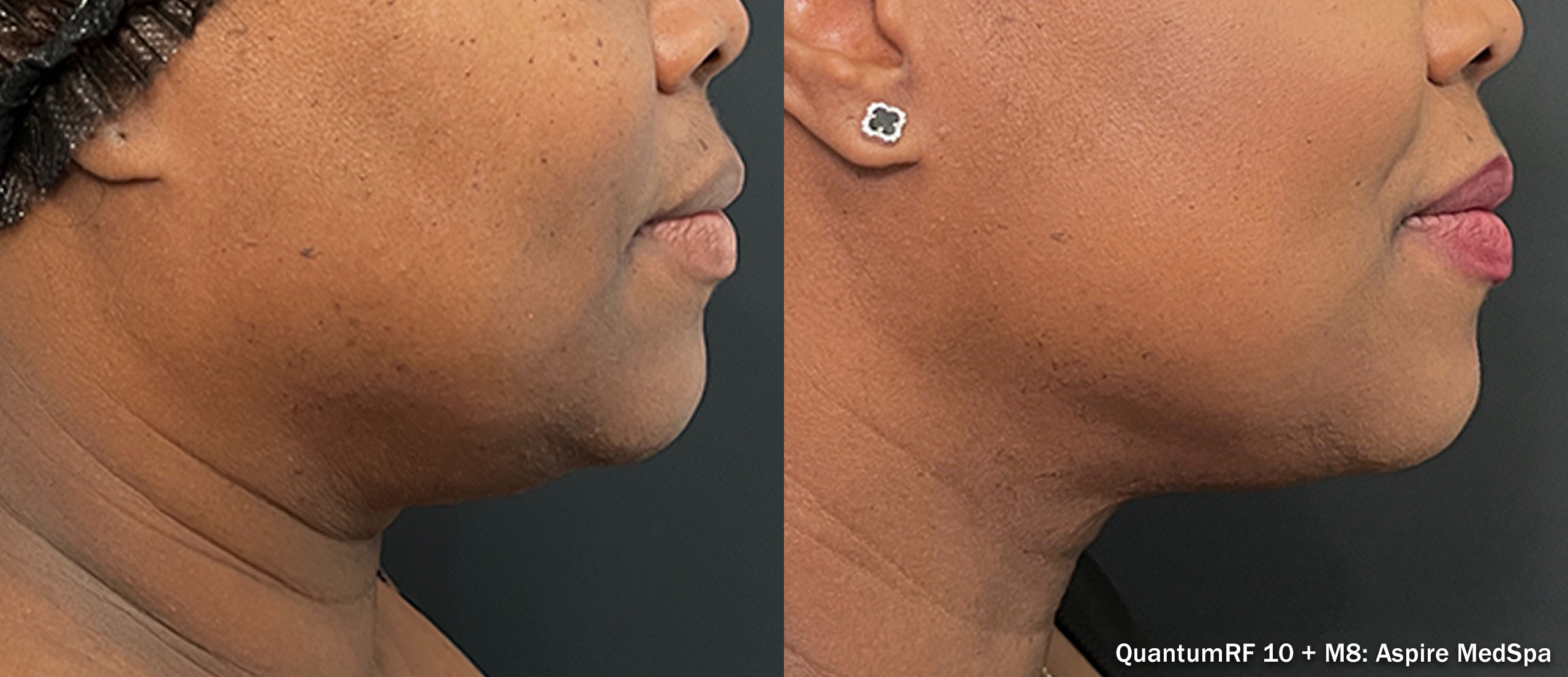 Side by side frames of a jawline and chin across a QuantumRF 10 and M8 course, credited to Aspire MedSpa, not a patient of this practice.