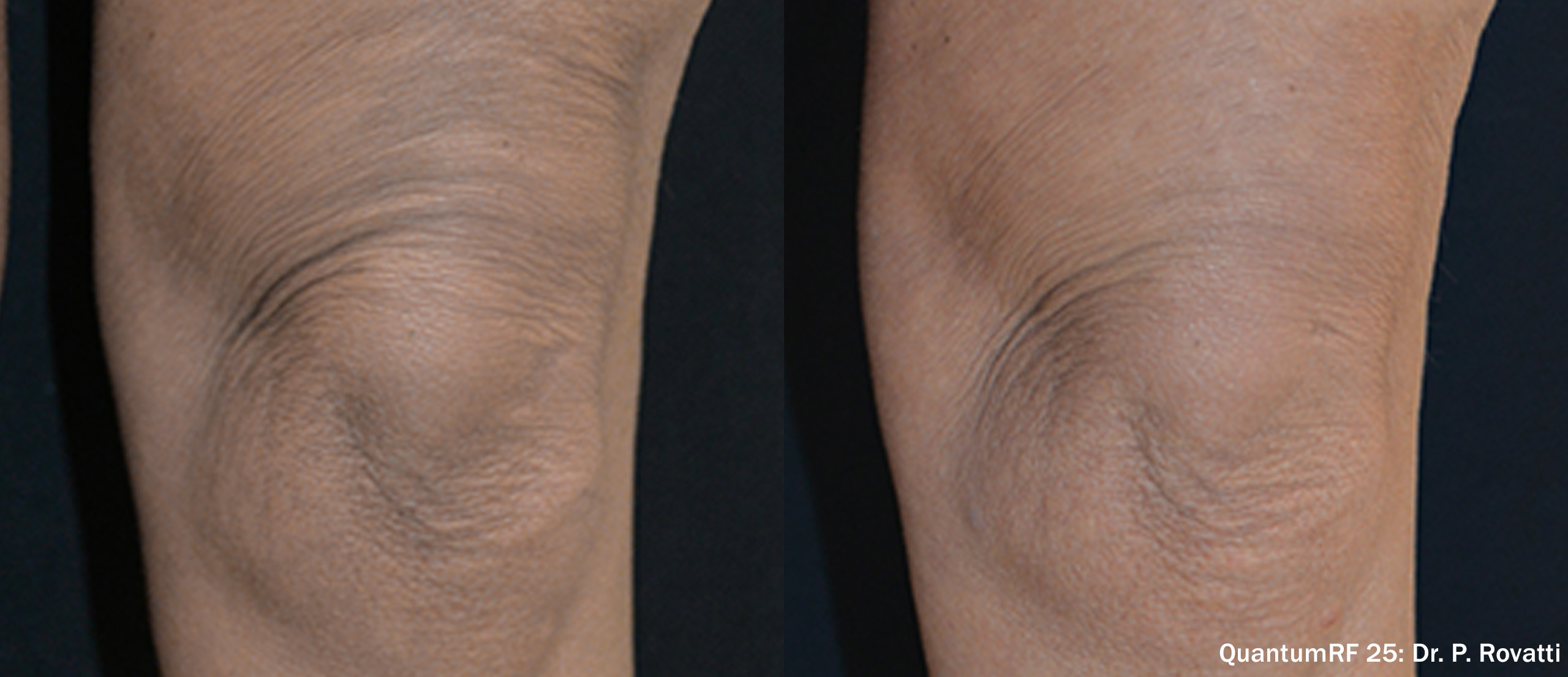 Side by side frames of the skin above a knee across a QuantumRF 25 course, credited to Dr. P. Rovatti, not a patient of this practice.