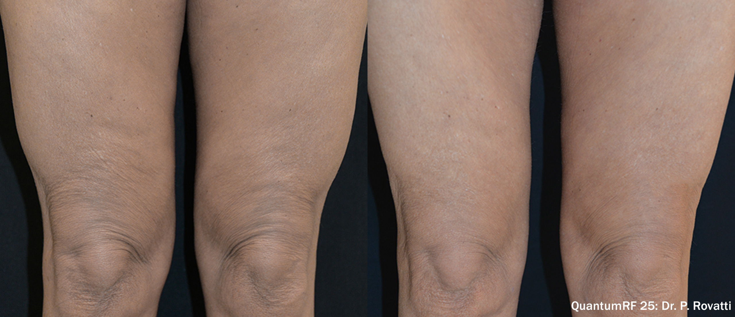 Side by side frames of thighs from the front across a QuantumRF 25 course, credited to Dr. P. Rovatti, not a patient of this practice